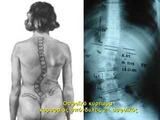 Οσφυϊκό κύρτωμαΟσφυϊκό κύρτωμα
κορυφαίος σπόνδυλος 2κορυφαίος σπόνδυλος 2οςος
οσφυϊκόςοσφυϊκός
 