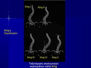 Ταξινόμηση σκολιωτικών
κυρτωμάτων κατά King
King I King II
King III King IV King V
King’s
Classification
 