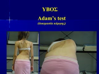 ΥΒΟΣ
Adam’s test
(δοκιμασία κάμψης)
 