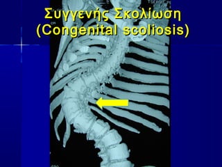 Συγγενής ΣκολίωσηΣυγγενής Σκολίωση
(Congenital scoliosis)(Congenital scoliosis)
 