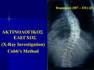 ΑΚΤΙΝΟΛΟΓΙΚΟΣ
ΕΛΕΓΧΟΣ
(X-Ray Investigation)
Cobb’s Method
θωρακικό (Θ7 – Ο1) (δ)
 