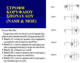 ΣΤΡΟΦΗ
ΚΟΡΥΦΑΙΟΥ
ΣΠΟΝΔΥΛΟΥ
(NASH & MOE)
 