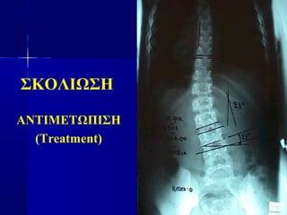 ΣΚΟΛΙΩΣΗ
ΑΝΤΙΜΕΤΩΠΙΣΗ
(Treatment)
 