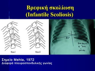 Βρεφική σκολίωσηΒρεφική σκολίωση
(Infantile Scoliosis)(Infantile Scoliosis)
Σημείο Mehta, 1972
Διαφορά πλευροσπονδυλικής γωνίας
 