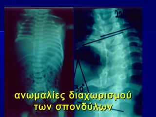 ανωμαλίες διαχωρισμούανωμαλίες διαχωρισμού
των σπονδύλωντων σπονδύλων
 