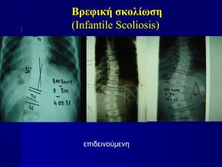 Βρεφική σκολίωση
(Infantile Scoliosis)
επιδεινούμενη
 