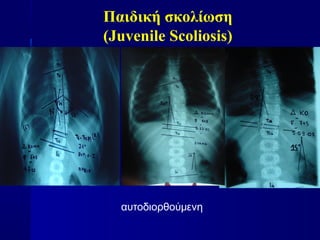 Παιδική σκολίωση
(Juvenile Scoliosis)
αυτοδιορθούμενη
 