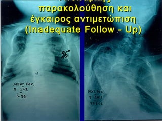 ΑνεπαρκήςΑνεπαρκής
παρακολούθηση καιπαρακολούθηση και
έγκαιρος αντιμετώπισηέγκαιρος αντιμετώπιση
(Inadequate Follow - Up)(Inadequate Follow - Up)
 
