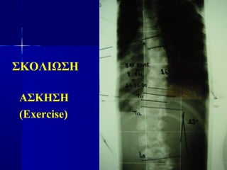 ΣΚΟΛΙΩΣΗ
ΑΣΚΗΣΗ
(Exercise)
 