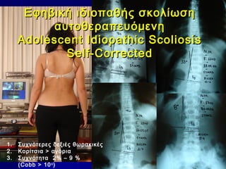 Εφηβική ιδιοπαθής σκολίωσηΕφηβική ιδιοπαθής σκολίωση
αυτοθεραπευόμενηαυτοθεραπευόμενη
Adolescent Idiopathic ScoliosisAdolescent Idiopathic Scoliosis
Self-CorrectedSelf-Corrected
1. Συχνότερες δεξιές θωρακικές
2. Κορίτσια > αγόρια
3. Συχνότητα 2% – 9 %
(Cobb > 10o
)
 