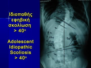 ΙδιοπαθήςΙδιοπαθής
εφηβικήεφηβική
σκολίωσησκολίωση
> 40> 40οο
AdolescentAdolescent
IdiopathicIdiopathic
ScoliosisScoliosis
> 40> 40οο
 