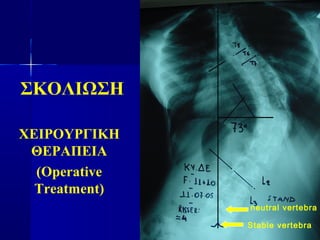 ΣΚΟΛΙΩΣΗ
ΧΕΙΡΟΥΡΓΙΚΗ
ΘΕΡΑΠΕΙΑ
(Operative
Treatment)
Stable vertebra
neutral vertebra
 