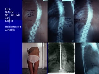 Ε.Στ.
Θ.14+2
Θ4 – Θ11 (Δ)
44ο
King III
Harrington rod
& Hooks
 