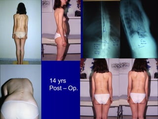 14 yrs
Post – Op.
 