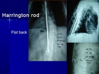 Harrington rod
Flat back
 