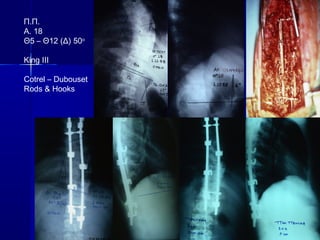 Π.Π.
Α. 18
Θ5 – Θ12 (Δ) 50ο
King III
Cotrel – Dubouset
Rods & Hooks
 