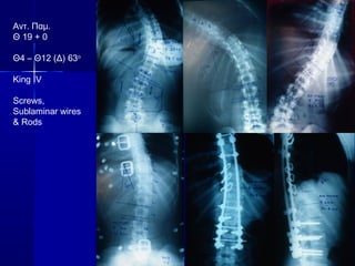 Αντ. Παμ.
Θ 19 + 0
Θ4 – Θ12 (Δ) 63ο
King IV
Screws,
Sublaminar wires
& Rods
 