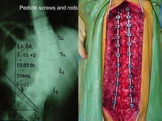 13 +2
Pedicle screws and rods
 