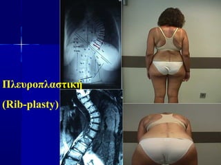 Πλευροπλαστική
(Rib-plasty)
 