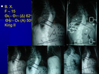 Β. Χ.Β. Χ.
F –F – 1515
ΘΘ66 - Θ- Θ1111 (Δ) 62(Δ) 62οο
ΘΘ1212 - Ο- Ο44 (Α) 50(Α) 50οο
King IIKing II
 