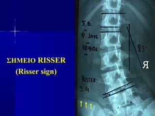 ΣΗΜΕΙΟ RISSER
(Risser sign)
 