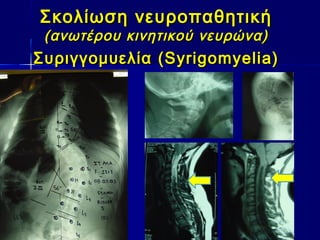 Σκολίωση νευροπαθητικήΣκολίωση νευροπαθητική
(ανωτέρου κινητικού νευρώνα)(ανωτέρου κινητικού νευρώνα)
ΣυριγγομυελίαΣυριγγομυελία (Syrigomyelia)(Syrigomyelia)
 