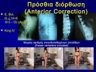 Πρόσθια διόρθωσηΠρόσθια διόρθωση
(Anterior Correction)(Anterior Correction)
Μικρός αριθμός σπονδυλοδεμένων επιπέδων
(Fewer verterbre included)
 Ε. Φιλ.Ε. Φιλ.
ΘΘ –– 14+614+6
ΘΘ1100 – Ο– Ο22 (Α) 52(Α) 52οο
 King IVKing IV
 