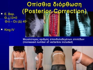 Οπίσθια διόρθωσηΟπίσθια διόρθωση
(Posterior Correction)(Posterior Correction)
Μεγαλύτερος αριθμός σπονδυλοδεμένων επιπέδων
(Increased number of verterbre included)
 Ε. Βαρ.Ε. Βαρ.
ΘΘ –– 13+013+0
ΘΘ1100 – Ο– Ο33 (Δ) 45(Δ) 45οο
 King IVKing IV
 