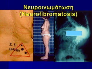 ΝευροινωμάτωσηΝευροινωμάτωση
(Neurofibromatosis)(Neurofibromatosis)
 