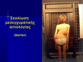 ΣκολίωσηΣκολίωση
μεσεγχυματικήςμεσεγχυματικής
αιτιολογίαςαιτιολογίας
((Marfan)Marfan)
 
