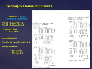 Пациентка П, 49 лет
профессия - бухгалтер
Vis OД = 0.6 сф+1,0=1.0
Vis OД = 0.08 сф+5,0=0.4
ПЗО ОД-23.6 мм
ОС-21,2 мм
после операции:
Vis OС= 0,6 цил-0.75 ах 20 = 0.8
Очки для чтения:
ОД= сф+2.5
ОС= сф +2.0
Монофокальная коррекцияМонофокальная коррекция
 