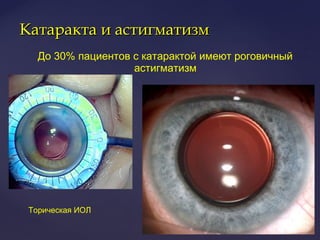 Катаракта и астигматизмКатаракта и астигматизм
До 30% пациентов с катарактой имеют роговичный
астигматизм
Торическая ИОЛ
 