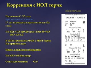 Пациентка С, 52 годаПациентка С, 52 года
преподаватель в школепреподаватель в школе
17 лет проведена кератотомия на оба17 лет проведена кератотомия на оба
глазаглаза
Vis OД = 0.3 сф+2,0 цил- 4.0ах 50 =0.9Vis OД = 0.3 сф+2,0 цил- 4.0ах 50 =0.9
ОС= 0.9-1.0ОС= 0.9-1.0
В 2014г проведена ФЭК с ИОЛ торикВ 2014г проведена ФЭК с ИОЛ торик
На правом глазуНа правом глазу
Через 1 год после операции:Через 1 год после операции:
Vis OU= 0,9 без корр.Vis OU= 0,9 без корр.
Очки для чтения:Очки для чтения: +2.0+2.0
ПОСЛЕ ОПЕРАЦИИПОСЛЕ ОПЕРАЦИИ
Коррекция с ИОЛ торикКоррекция с ИОЛ торик
 