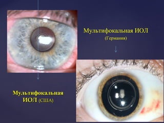 стандартнаястандартная
МультифокальнаяМультифокальная
ИОЛИОЛ (США)(США)
Мультифокальная ИОЛ
(Германия)
 