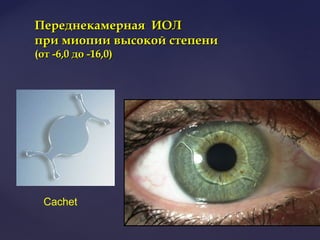 Переднекамерная ИОЛПереднекамерная ИОЛ
при миопии высокой степенипри миопии высокой степени
(от -6,0 до -16,0)(от -6,0 до -16,0)
Cachet
 