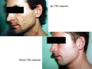 До ТЭС-терапии
После ТЭС-терапии
 