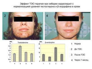 Эффект ТЭС-терапии при себорее коррелирует с
нормализацией уровней тестостерона и β-эндорфина в крови
0
0,5
1
1,5
2
2,5
3
3,5
4
1 2 3 4
0
5
10
15
20
1 2 3 4
1
2
3
4
Норма
До ТЭС
После ТЭС
Через 1 месяц
Testosterone β-endorphin
nM/L pM/L
2 4
 