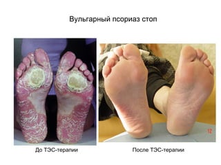 Вульгарный псориаз стоп
До ТЭС-терапии После ТЭС-терапии
 
