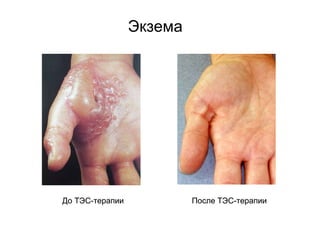 До ТЭС-терапии После ТЭС-терапии
Экзема
До ТЭС-терапии После ТЭС-терапии
 