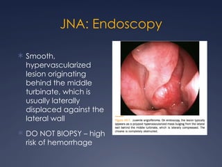 Comprehensive Overview of Fungal Sinusitis and Benign Sinonasal Tumors ...
