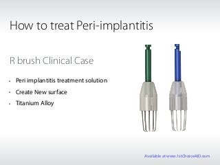 R brush Clinical Case
• Peri implantitis treatment solution
• Create New surface
• Titanium Alloy
How to treat Peri-implantitis
Available at www.1stChoiceAID.com
 