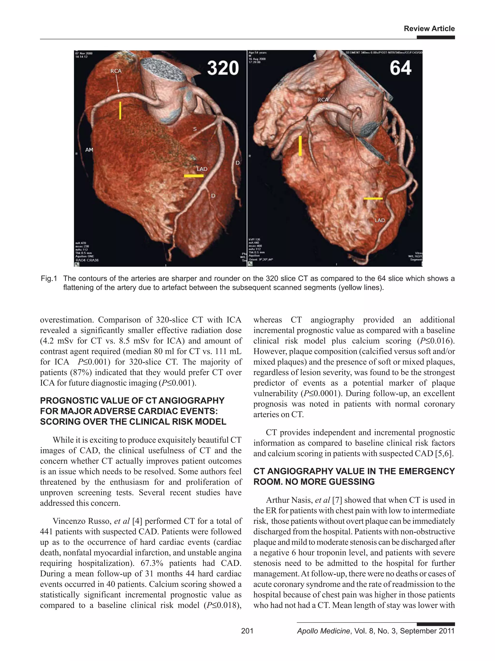 Review Article
201 Apollo Medicine, Vol. 8, No. 3, September 2011
overestimation. Comparison of 320-slice CT with ICA
revealed a significantly smaller effective radiation dose
(4.2 mSv for CT vs. 8.5 mSv for ICA) and amount of
contrast agent required (median 80 ml for CT vs. 111 mL
for ICA P≤0.001) for 320-slice CT. The majority of
patients (87%) indicated that they would prefer CT over
ICA for future diagnostic imaging (P≤0.001).
PROGNOSTIC VALUE OF CT ANGIOGRAPHY
FOR MAJOR ADVERSE CARDIAC EVENTS:
SCORING OVER THE CLINICAL RISK MODEL
While it is exciting to produce exquisitely beautiful CT
images of CAD, the clinical usefulness of CT and the
concern whether CT actually improves patient outcomes
is an issue which needs to be resolved. Some authors feel
threatened by the enthusiasm for and proliferation of
unproven screening tests. Several recent studies have
addressed this concern.
Vincenzo Russo, et al [4] performed CT for a total of
441 patients with suspected CAD. Patients were followed
up as to the occurrence of hard cardiac events (cardiac
death, nonfatal myocardial infarction, and unstable angina
requiring hospitalization). 67.3% patients had CAD.
During a mean follow-up of 31 months 44 hard cardiac
events occurred in 40 patients. Calcium scoring showed a
statistically significant incremental prognostic value as
compared to a baseline clinical risk model (P≤0.018),
whereas CT angiography provided an additional
incremental prognostic value as compared with a baseline
clinical risk model plus calcium scoring (P≤0.016).
However, plaque composition (calcified versus soft and/or
mixed plaques) and the presence of soft or mixed plaques,
regardless of lesion severity, was found to be the strongest
predictor of events as a potential marker of plaque
vulnerability (P≤0.0001). During follow-up, an excellent
prognosis was noted in patients with normal coronary
arteries on CT.
CT provides independent and incremental prognostic
information as compared to baseline clinical risk factors
and calcium scoring in patients with suspected CAD [5,6].
CT ANGIOGRAPHY VALUE IN THE EMERGENCY
ROOM. NO MORE GUESSING
Arthur Nasis, et al [7] showed that when CT is used in
the ER for patients with chest pain with low to intermediate
risk, those patients without overt plaque can be immediately
discharged from the hospital. Patients with non-obstructive
plaque and mild to moderate stenosis can be discharged after
a negative 6 hour troponin level, and patients with severe
stenosis need to be admitted to the hospital for further
management.At follow-up, there were no deaths or cases of
acute coronary syndrome and the rate of readmission to the
hospital because of chest pain was higher in those patients
who had not had a CT. Mean length of stay was lower with
Fig.1 The contours of the arteries are sharper and rounder on the 320 slice CT as compared to the 64 slice which shows a
flattening of the artery due to artefact between the subsequent scanned segments (yellow lines).
 