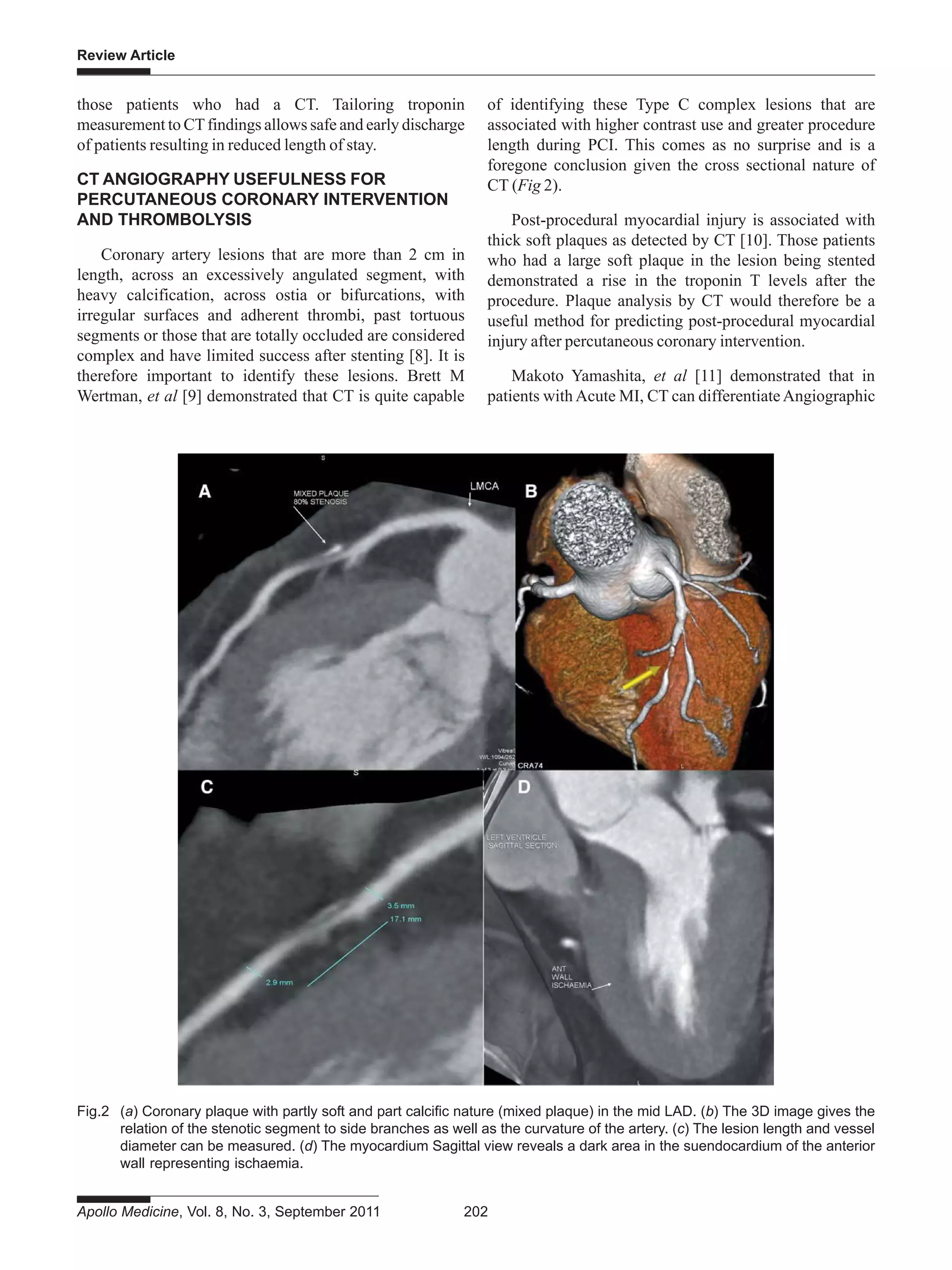 Review Article
Apollo Medicine, Vol. 8, No. 3, September 2011 202
those patients who had a CT. Tailoring troponin
measurement to CTfindings allows safe and early discharge
of patients resulting in reduced length of stay.
CT ANGIOGRAPHY USEFULNESS FOR
PERCUTANEOUS CORONARY INTERVENTION
AND THROMBOLYSIS
Coronary artery lesions that are more than 2 cm in
length, across an excessively angulated segment, with
heavy calcification, across ostia or bifurcations, with
irregular surfaces and adherent thrombi, past tortuous
segments or those that are totally occluded are considered
complex and have limited success after stenting [8]. It is
therefore important to identify these lesions. Brett M
Wertman, et al [9] demonstrated that CT is quite capable
of identifying these Type C complex lesions that are
associated with higher contrast use and greater procedure
length during PCI. This comes as no surprise and is a
foregone conclusion given the cross sectional nature of
CT (Fig 2).
Post-procedural myocardial injury is associated with
thick soft plaques as detected by CT [10]. Those patients
who had a large soft plaque in the lesion being stented
demonstrated a rise in the troponin T levels after the
procedure. Plaque analysis by CT would therefore be a
useful method for predicting post-procedural myocardial
injury after percutaneous coronary intervention.
Makoto Yamashita, et al [11] demonstrated that in
patients with Acute MI, CT can differentiateAngiographic
Fig.2 (a) Coronary plaque with partly soft and part calcific nature (mixed plaque) in the mid LAD. (b) The 3D image gives the
relation of the stenotic segment to side branches as well as the curvature of the artery. (c) The lesion length and vessel
diameter can be measured. (d) The myocardium Sagittal view reveals a dark area in the suendocardium of the anterior
wall representing ischaemia.
 