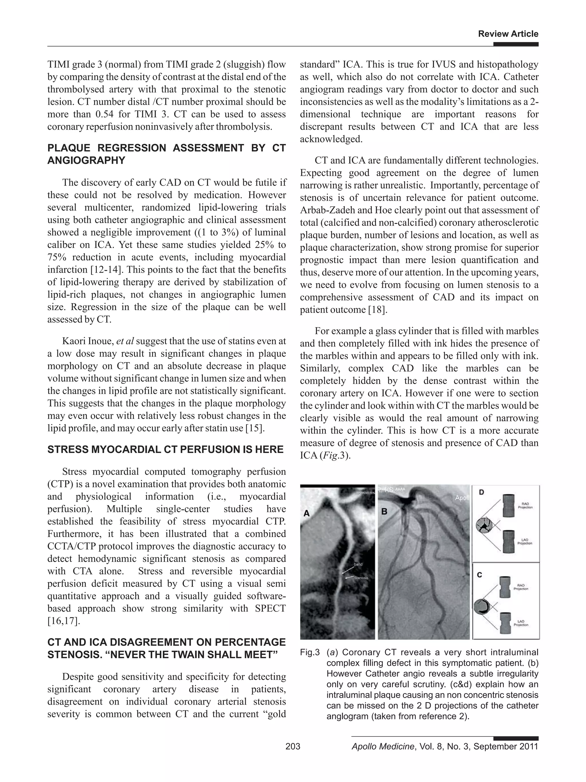 Review Article
203 Apollo Medicine, Vol. 8, No. 3, September 2011
TIMI grade 3 (normal) from TIMI grade 2 (sluggish) flow
by comparing the density of contrast at the distal end of the
thrombolysed artery with that proximal to the stenotic
lesion. CT number distal /CT number proximal should be
more than 0.54 for TIMI 3. CT can be used to assess
coronary reperfusion noninvasively after thrombolysis.
PLAQUE REGRESSION ASSESSMENT BY CT
ANGIOGRAPHY
The discovery of early CAD on CT would be futile if
these could not be resolved by medication. However
several multicenter, randomized lipid-lowering trials
using both catheter angiographic and clinical assessment
showed a negligible improvement ((1 to 3%) of luminal
caliber on ICA. Yet these same studies yielded 25% to
75% reduction in acute events, including myocardial
infarction [12-14]. This points to the fact that the benefits
of lipid-lowering therapy are derived by stabilization of
lipid-rich plaques, not changes in angiographic lumen
size. Regression in the size of the plaque can be well
assessed by CT.
Kaori Inoue, et al suggest that the use of statins even at
a low dose may result in significant changes in plaque
morphology on CT and an absolute decrease in plaque
volume without significant change in lumen size and when
the changes in lipid profile are not statistically significant.
This suggests that the changes in the plaque morphology
may even occur with relatively less robust changes in the
lipid profile, and may occur early after statin use [15].
STRESS MYOCARDIAL CT PERFUSION IS HERE
Stress myocardial computed tomography perfusion
(CTP) is a novel examination that provides both anatomic
and physiological information (i.e., myocardial
perfusion). Multiple single-center studies have
established the feasibility of stress myocardial CTP.
Furthermore, it has been illustrated that a combined
CCTA/CTP protocol improves the diagnostic accuracy to
detect hemodynamic significant stenosis as compared
with CTA alone. Stress and reversible myocardial
perfusion deficit measured by CT using a visual semi
quantitative approach and a visually guided software-
based approach show strong similarity with SPECT
[16,17].
CT AND ICA DISAGREEMENT ON PERCENTAGE
STENOSIS. “NEVER THE TWAIN SHALL MEET”
Despite good sensitivity and specificity for detecting
significant coronary artery disease in patients,
disagreement on individual coronary arterial stenosis
severity is common between CT and the current “gold
standard” ICA. This is true for IVUS and histopathology
as well, which also do not correlate with ICA. Catheter
angiogram readings vary from doctor to doctor and such
inconsistencies as well as the modality’s limitations as a 2-
dimensional technique are important reasons for
discrepant results between CT and ICA that are less
acknowledged.
CT and ICA are fundamentally different technologies.
Expecting good agreement on the degree of lumen
narrowing is rather unrealistic. Importantly, percentage of
stenosis is of uncertain relevance for patient outcome.
Arbab-Zadeh and Hoe clearly point out that assessment of
total (calcified and non-calcified) coronary atherosclerotic
plaque burden, number of lesions and location, as well as
plaque characterization, show strong promise for superior
prognostic impact than mere lesion quantification and
thus, deserve more of our attention. In the upcoming years,
we need to evolve from focusing on lumen stenosis to a
comprehensive assessment of CAD and its impact on
patient outcome [18].
For example a glass cylinder that is filled with marbles
and then completely filled with ink hides the presence of
the marbles within and appears to be filled only with ink.
Similarly, complex CAD like the marbles can be
completely hidden by the dense contrast within the
coronary artery on ICA. However if one were to section
the cylinder and look within with CT the marbles would be
clearly visible as would the real amount of narrowing
within the cylinder. This is how CT is a more accurate
measure of degree of stenosis and presence of CAD than
ICA (Fig.3).
Fig.3 (a) Coronary CT reveals a very short intraluminal
complex filling defect in this symptomatic patient. (b)
However Catheter angio reveals a subtle irregularity
only on very careful scrutiny. (c&d) explain how an
intraluminal plaque causing an non concentric stenosis
can be missed on the 2 D projections of the catheter
anglogram (taken from reference 2).
 