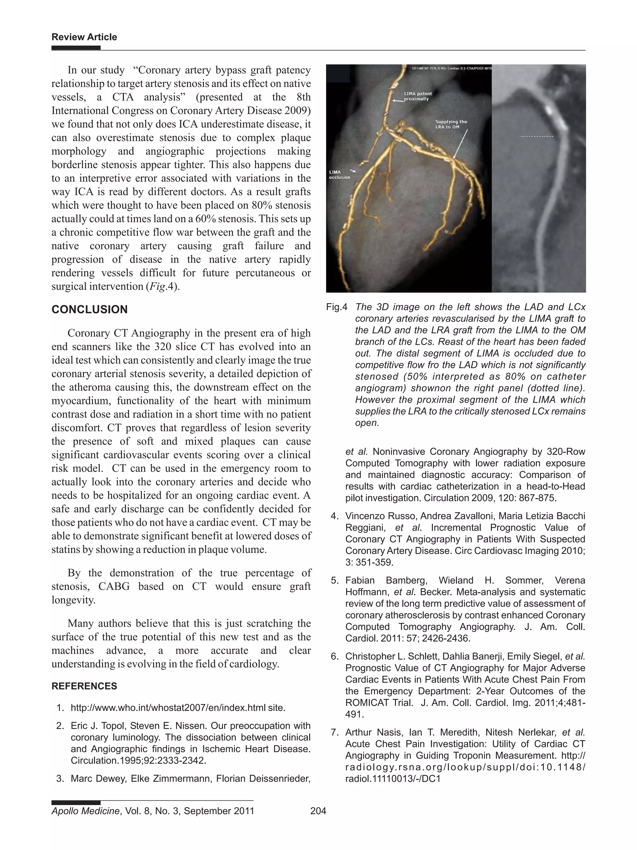 Review Article
Apollo Medicine, Vol. 8, No. 3, September 2011 204
In our study “Coronary artery bypass graft patency
relationship to target artery stenosis and its effect on native
vessels, a CTA analysis” (presented at the 8th
International Congress on Coronary Artery Disease 2009)
we found that not only does ICA underestimate disease, it
can also overestimate stenosis due to complex plaque
morphology and angiographic projections making
borderline stenosis appear tighter. This also happens due
to an interpretive error associated with variations in the
way ICA is read by different doctors. As a result grafts
which were thought to have been placed on 80% stenosis
actually could at times land on a 60% stenosis. This sets up
a chronic competitive flow war between the graft and the
native coronary artery causing graft failure and
progression of disease in the native artery rapidly
rendering vessels difficult for future percutaneous or
surgical intervention (Fig.4).
CONCLUSION
Coronary CT Angiography in the present era of high
end scanners like the 320 slice CT has evolved into an
ideal test which can consistently and clearly image the true
coronary arterial stenosis severity, a detailed depiction of
the atheroma causing this, the downstream effect on the
myocardium, functionality of the heart with minimum
contrast dose and radiation in a short time with no patient
discomfort. CT proves that regardless of lesion severity
the presence of soft and mixed plaques can cause
significant cardiovascular events scoring over a clinical
risk model. CT can be used in the emergency room to
actually look into the coronary arteries and decide who
needs to be hospitalized for an ongoing cardiac event. A
safe and early discharge can be confidently decided for
those patients who do not have a cardiac event. CT may be
able to demonstrate significant benefit at lowered doses of
statins by showing a reduction in plaque volume.
By the demonstration of the true percentage of
stenosis, CABG based on CT would ensure graft
longevity.
Many authors believe that this is just scratching the
surface of the true potential of this new test and as the
machines advance, a more accurate and clear
understanding is evolving in the field of cardiology.
REFERENCES
1. http://www.who.int/whostat2007/en/index.html site.
2. Eric J. Topol, Steven E. Nissen. Our preoccupation with
coronary luminology. The dissociation between clinical
and Angiographic findings in Ischemic Heart Disease.
Circulation.1995;92:2333-2342.
3. Marc Dewey, Elke Zimmermann, Florian Deissenrieder,
et al. Noninvasive Coronary Angiography by 320-Row
Computed Tomography with lower radiation exposure
and maintained diagnostic accuracy: Comparison of
results with cardiac catheterization in a head-to-Head
pilot investigation. Circulation 2009, 120: 867-875.
4. Vincenzo Russo, Andrea Zavalloni, Maria Letizia Bacchi
Reggiani, et al. Incremental Prognostic Value of
Coronary CT Angiography in Patients With Suspected
Coronary Artery Disease. Circ Cardiovasc Imaging 2010;
3: 351-359.
5. Fabian Bamberg, Wieland H. Sommer, Verena
Hoffmann, et al. Becker. Meta-analysis and systematic
review of the long term predictive value of assessment of
coronary atherosclerosis by contrast enhanced Coronary
Computed Tomography Angiography. J. Am. Coll.
Cardiol. 2011: 57; 2426-2436.
6. Christopher L. Schlett, Dahlia Banerji, Emily Siegel, et al.
Prognostic Value of CT Angiography for Major Adverse
Cardiac Events in Patients With Acute Chest Pain From
the Emergency Department: 2-Year Outcomes of the
ROMICAT Trial. J. Am. Coll. Cardiol. Img. 2011;4;481-
491.
7. Arthur Nasis, Ian T. Meredith, Nitesh Nerlekar, et al.
Acute Chest Pain Investigation: Utility of Cardiac CT
Angiography in Guiding Troponin Measurement. http://
radiology.rsna.org/lookup/suppl/doi:10.1148/
radiol.11110013/-/DC1
Fig.4 The 3D image on the left shows the LAD and LCx
coronary arteries revascularised by the LIMA graft to
the LAD and the LRA graft from the LIMA to the OM
branch of the LCs. Reast of the heart has been faded
out. The distal segment of LIMA is occluded due to
competitive flow fro the LAD which is not significantly
stenosed (50% interpreted as 80% on catheter
angiogram) shownon the right panel (dotted line).
However the proximal segment of the LIMA which
supplies the LRA to the critically stenosed LCx remains
open.
 