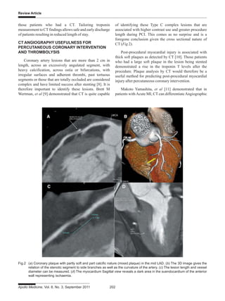 Review Article
Apollo Medicine, Vol. 8, No. 3, September 2011 202
those patients who had a CT. Tailoring troponin
measurement to CTfindings allows safe and early discharge
of patients resulting in reduced length of stay.
CT ANGIOGRAPHY USEFULNESS FOR
PERCUTANEOUS CORONARY INTERVENTION
AND THROMBOLYSIS
Coronary artery lesions that are more than 2 cm in
length, across an excessively angulated segment, with
heavy calcification, across ostia or bifurcations, with
irregular surfaces and adherent thrombi, past tortuous
segments or those that are totally occluded are considered
complex and have limited success after stenting [8]. It is
therefore important to identify these lesions. Brett M
Wertman, et al [9] demonstrated that CT is quite capable
of identifying these Type C complex lesions that are
associated with higher contrast use and greater procedure
length during PCI. This comes as no surprise and is a
foregone conclusion given the cross sectional nature of
CT (Fig 2).
Post-procedural myocardial injury is associated with
thick soft plaques as detected by CT [10]. Those patients
who had a large soft plaque in the lesion being stented
demonstrated a rise in the troponin T levels after the
procedure. Plaque analysis by CT would therefore be a
useful method for predicting post-procedural myocardial
injury after percutaneous coronary intervention.
Makoto Yamashita, et al [11] demonstrated that in
patients with Acute MI, CT can differentiateAngiographic
Fig.2 (a) Coronary plaque with partly soft and part calcific nature (mixed plaque) in the mid LAD. (b) The 3D image gives the
relation of the stenotic segment to side branches as well as the curvature of the artery. (c) The lesion length and vessel
diameter can be measured. (d) The myocardium Sagittal view reveals a dark area in the suendocardium of the anterior
wall representing ischaemia.
 