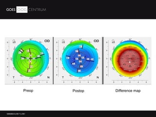 Relex Smile laser surgery | PPT