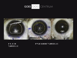 Relex Smile laser surgery | PPT