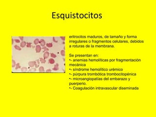 Esquistocitos
eritrocitos maduros, de tamaño y forma
irregulares o fragmentos celulares, debidos
a roturas de la membrana.
Se presentan en:
•- anemias hemolíticas por fragmentación
mecánica
•- síndrome hemolítico urémico
•- púrpura trombótica trombocitopénica
•- microangiopatías del embarazo y
puerperio.
•- Coagulación intravascular diseminada
 