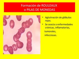 Formación de ROULEAUX
o PILAS DE MONEDAS
• Aglutinación de glóbulos
rojos.
• Se asocia a enfermedades
crónicas, inflamatorias,
tumorales,
infecciosas.
 
